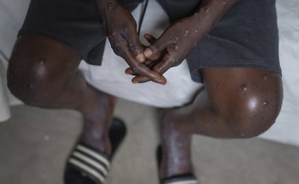 Mpox: ¿es más mortal la variante de la viruela del mono por la que se declaró emergencia internacional?