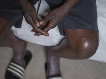 Mpox: ¿es más mortal la variante de la viruela del mono por la que se declaró emergencia internacional?