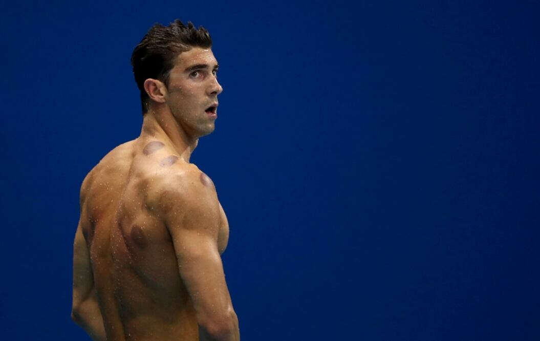 Hace unos días, la imagen de Michael Phelps lleno de círculos morados en su espalda dio la vuelta al mundo. Foto Reuters
