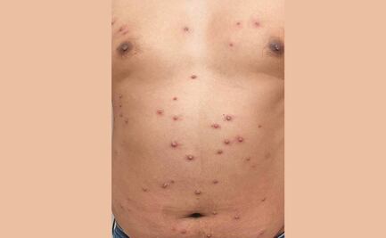 Así fue contagiarse de viruela del mono: me revisaron en la calle, fue todo un calvario