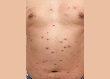 Así fue contagiarse de viruela del mono: me revisaron en la calle, fue todo un calvario