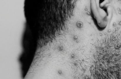 Chiapas acumula 14 casos de viruela del mono; reporta 4 contagios más 