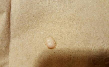 Mujer halla un trozo de dedo en su ensalada