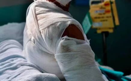 Sujeto rocía alcohol y le prende fuego a mujer en situación de calle en Venustiano Carranza