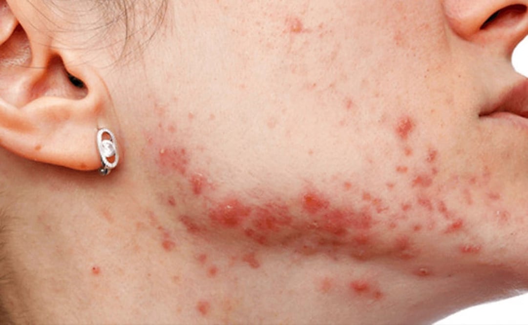 Foto: Fundación Mexicana para la Dermatología