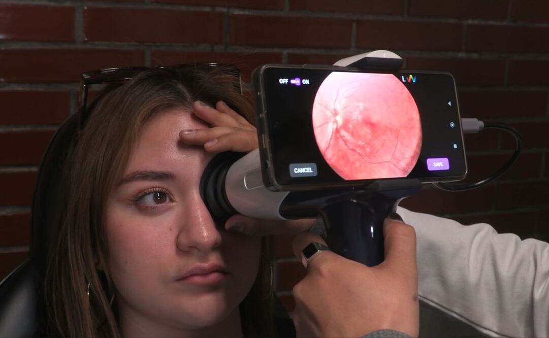 El nombre correcto del glaucoma es neuropatía óptica glaucomatosa. Foto: Especial