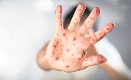 Hay más casos de sarampión que de coronavirus en CDMX