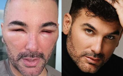 Mauricio Mejía aclara por qué apareció con el rostro irreconocible