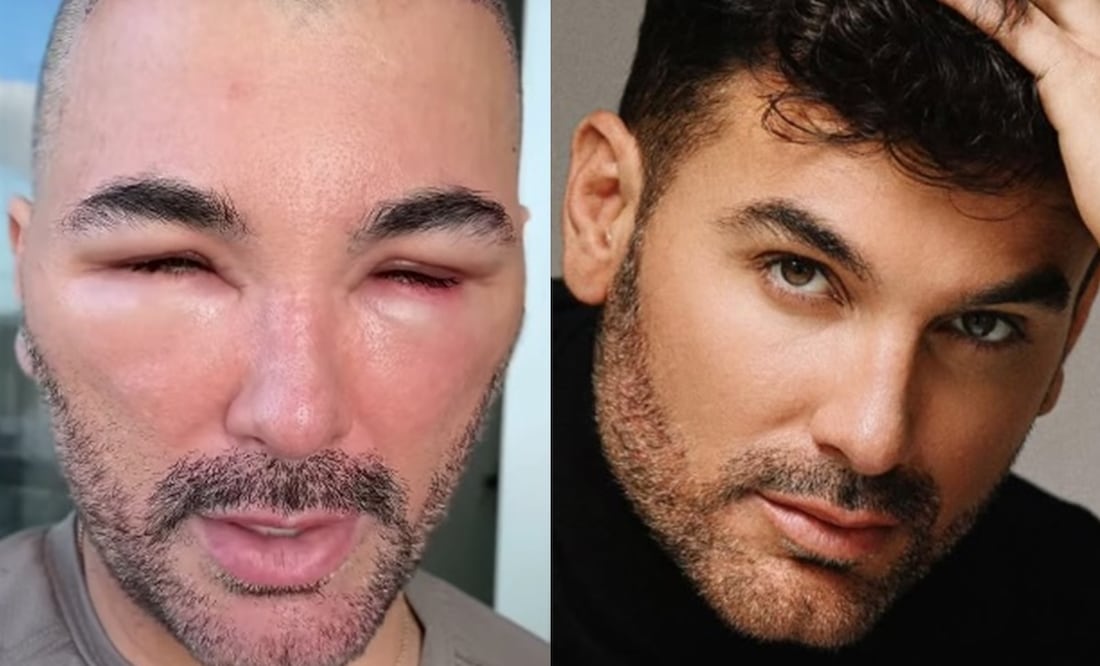 Mauricio Mejía aclara por qué apareció con el rostro irreconocible