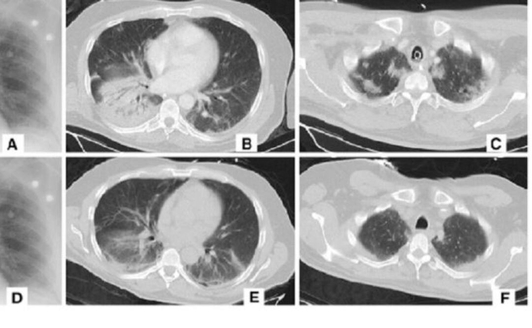 Alibaba afirmó que su nuevo sistema puede detectar coronavirus en tomografías computarizadas de pacientes con una precisión del 96% contra los casos de neumonía viral