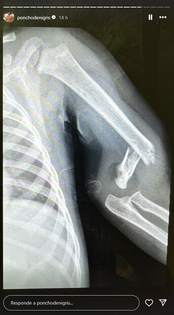 Poncho de Nigris comparte radiografía de su hijo Toñito, que tuvo una lesión en el brazo.
Foto: Instagram