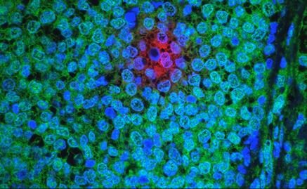 Identifican proteínas que podrían curar cánceres como la leucemia