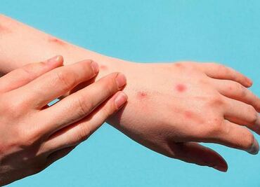 Morelos confirma segundo caso de viruela del mono