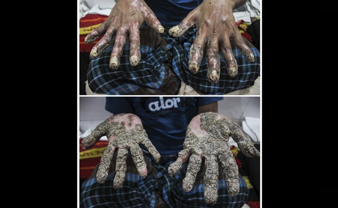 Después de una decena de operaciones quirúrgicas en sus extremidades, Abul afronta ahora un proceso de "embellecimiento". (FOTOS: EFE/Igor G. Barbero)