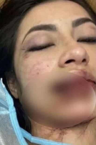 "Está viva de milagro"; modelo que sufrió brutal golpiza se recupera lentamente; su agresor sigue libre