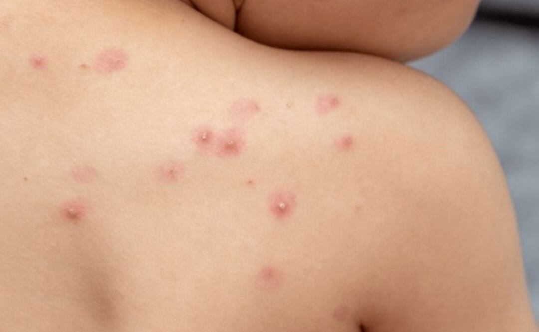 Detectan seis casos de viruela símica en Yucatán; activan vigilancia epidemiológica en Mérida. Foto: Especial