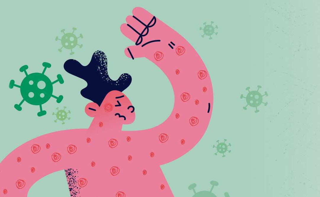 Brotes de sarampión en México y Estados Unidos. Foto: Istock