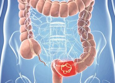 Avances contra el cáncer de colon