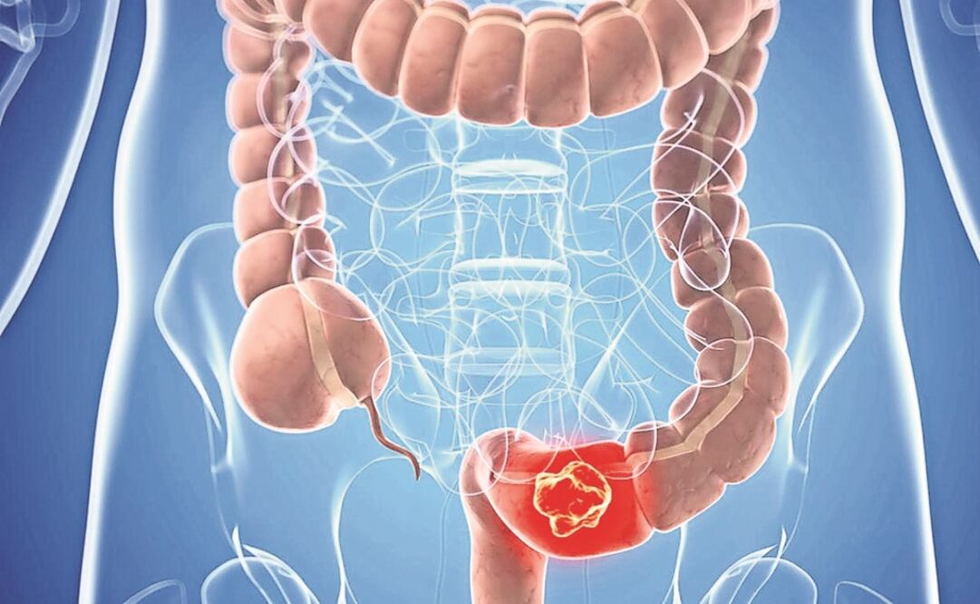 En 2015, este tipo de cáncer le quitó la vida a 774 mil personas en todo el mundo. (ESPECIAL)