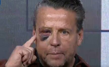 Alfredo Adame asegura que su ojo podría quedar inservible