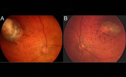 Vinculan zika con daño ocular