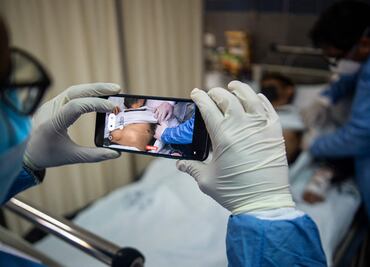 Detectan por primera vez viruela del mono, Covid-19 y VIH al mismo tiempo en paciente italiano