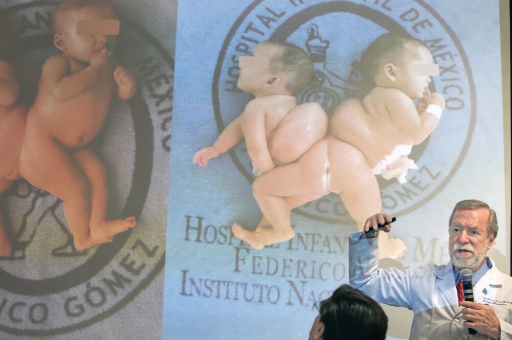 En el Hospital Infantil de México Federico Gómez se ofreció una conferencia de prensa sobre el caso de las niñas siamesas que fueron separadas (VALENTE ROSAS. EL UNIVERSAL)