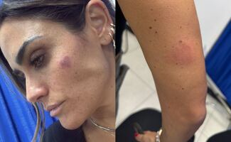 Tras enfrentamiento con ambulantes, colaboradores Alessandra Rojo presentan tres fracturas; alcaldesa reprueba violencia