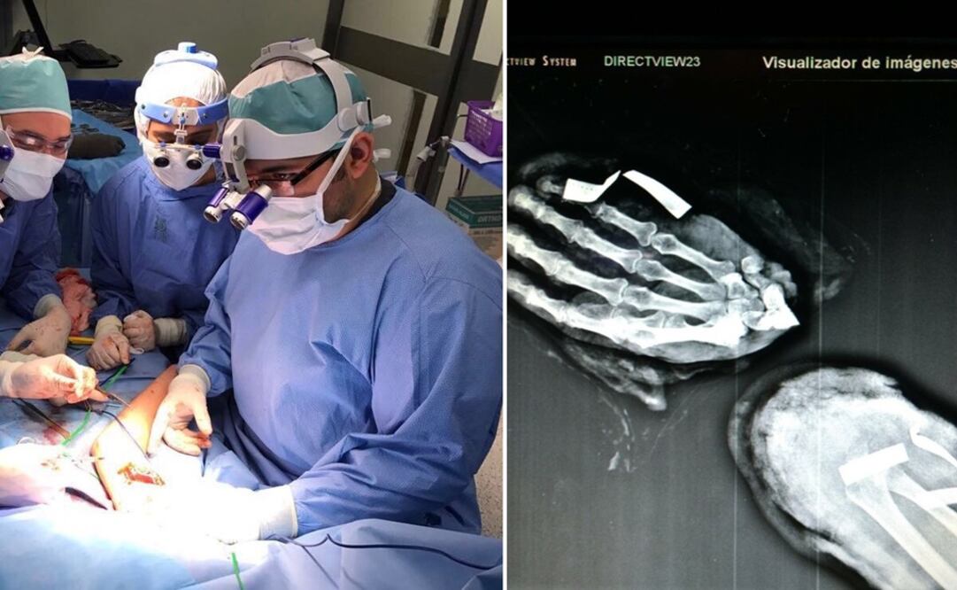 Aunque los especialistas califican como exitoso el injerto, tienen que pasar 28 días en espera a fin de que no se presente ninguna complicación y pueda comenzar el proceso de rehabilitación (Foto: Especial)