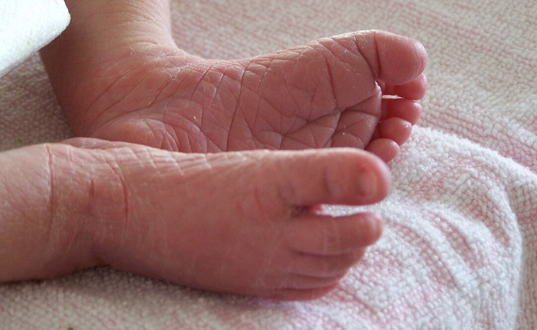 La piel de mariposa requiere de cuidados en la higiene diaria y una dieta cargada de proteínas. Foto: Unsplash