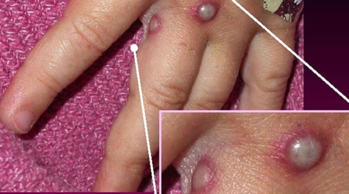 Viruela del mono: Cinco claves para comprender la infección 