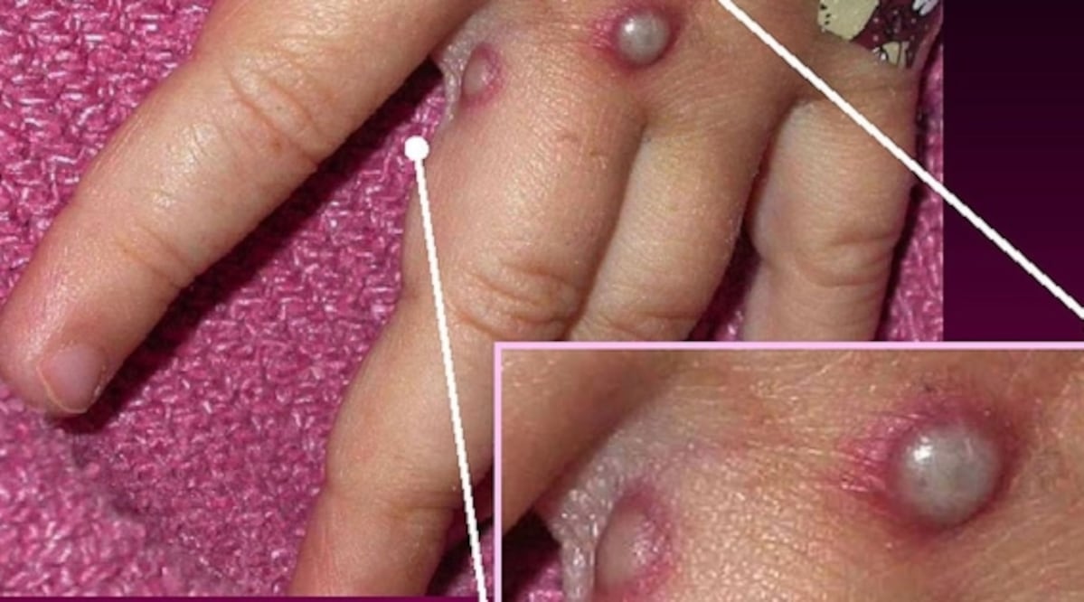 Tamaulipas confirma un caso positivo de viruela del mono. (Foto: especial)