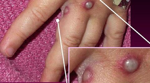 Tamaulipas confirma un caso positivo de viruela del mono