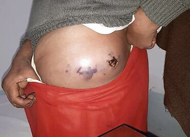 Mueren 5 por inyección ilegal en la Cañada