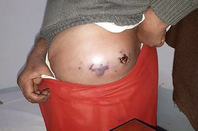 Mueren 5 por inyección ilegal en la Cañada