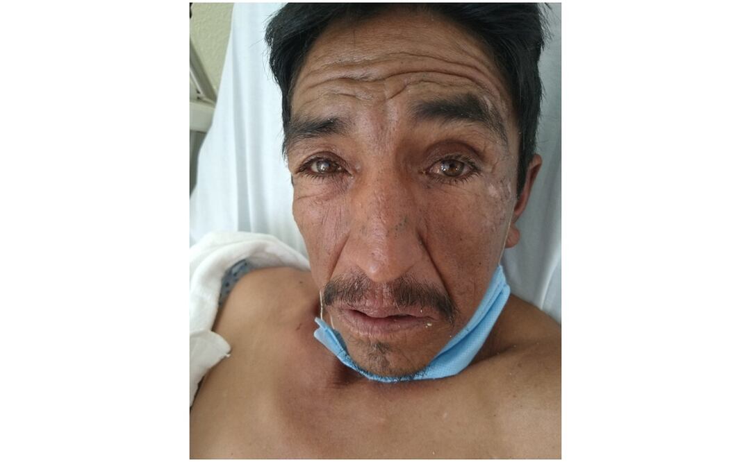 Alejandro ingresó al Hospital Municipal “San Juan Zitlaltepec” el pasado 24 de marzo a consecuencia de un Evento Vascular Cerebral 