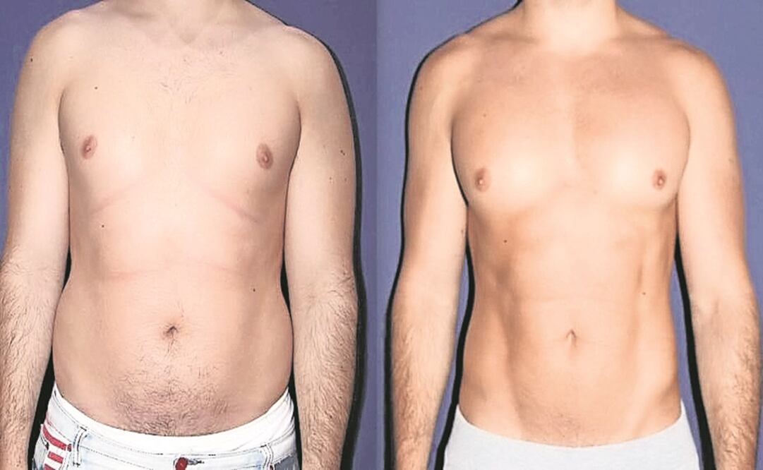 El antes y el después de Iván. “Eran muchísimos sacrificios en el gimnasio. Era demasiado tiempo y esfuerzo, por eso me animé” (Cortesía del Doctor Francisco Pérez)