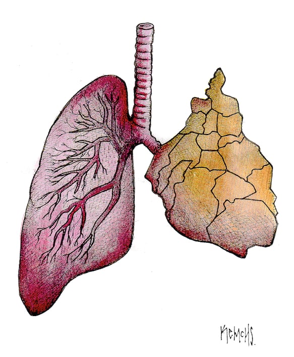Pulmón dañado 