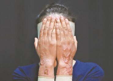 Avala Senado dar hasta 21 años de cárcel a quienes ataquen con ácido a mujeres