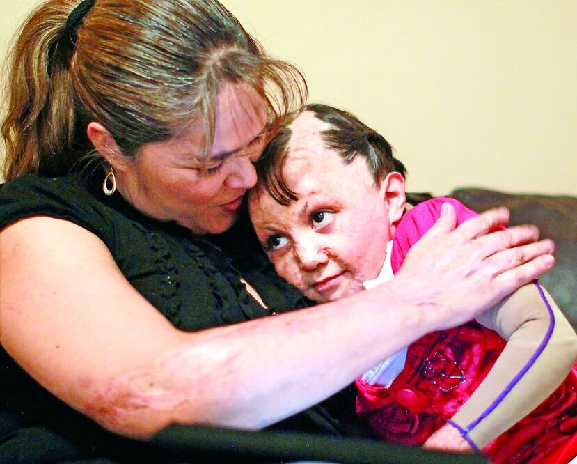 Tiene heridas abiertas en sus brazos y piernas, pero asegura que no le duelen (GERMÁN ESPINOSA / EL UNIVERSAL)