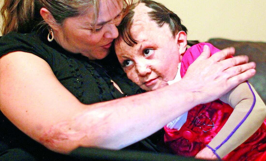 Tiene heridas abiertas en sus brazos y piernas, pero asegura que no le duelen (GERMÁN ESPINOSA / EL UNIVERSAL)