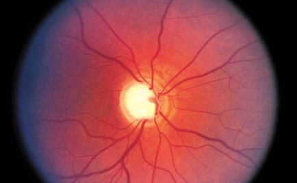 Crean compuesto que podría retrasar la evolución del glaucoma