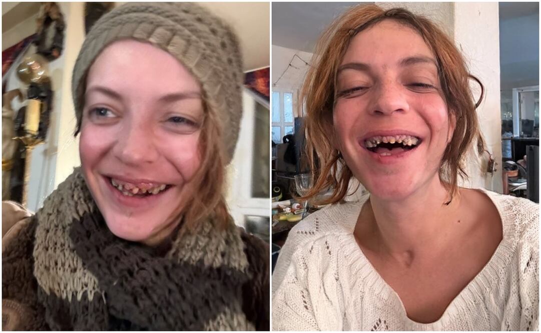 El deterioro dental de Camilo Blanes es cada vez más alarmante. Así se muestra en redes sociales.