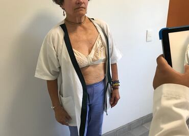 Estudiantes mexicanos elaboran prótesis mamarias en 3D