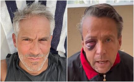 ¡Con el ojo morado! Arath de la Torre queda "igualito" que Alfredo Adame