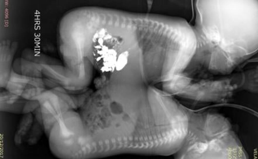 Médicos del IMSS separan a siameses unidos por tórax y abdomen