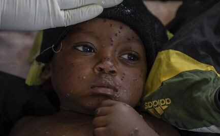 Mpox: África registra más de 32 mil 400 casos y 840 muertes por esta enfermedad en lo que va de 2024