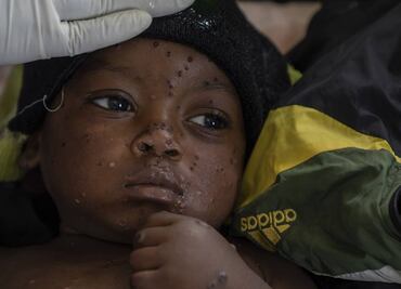 Mpox: África registra más de 32 mil 400 casos y 840 muertes por esta enfermedad en lo que va de 2024