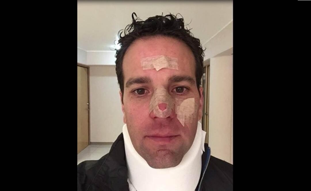 El conductor de televisión relató en redes sociales que asistió a un juego con periodistas y miembros de los Diablos Rojos, momento en el que fue golpeado accidentalmente por un cátcher, lo que le causó diversas lesiones