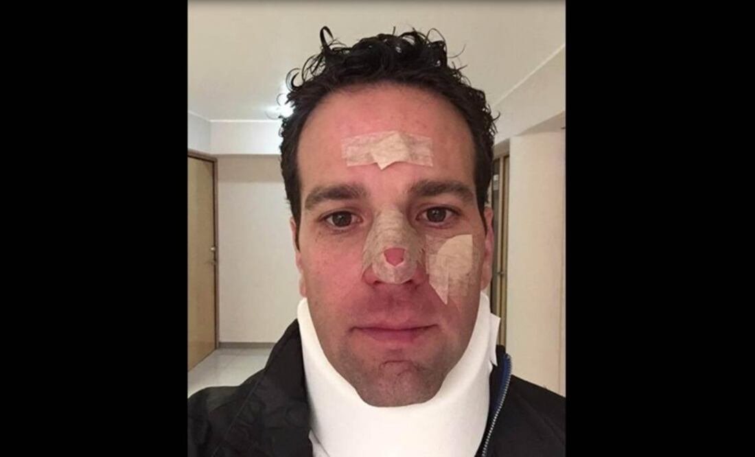 El conductor de televisión relató en redes sociales que asistió a un juego con periodistas y miembros de los Diablos Rojos, momento en el que fue golpeado accidentalmente por un cátcher, lo que le causó diversas lesiones